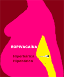 Uso combinado de Ropivacaína hiperbárica e hipobárica