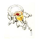 Hematoma espinal subaracnoideo después de anestesia raquídea: reporte de un caso.